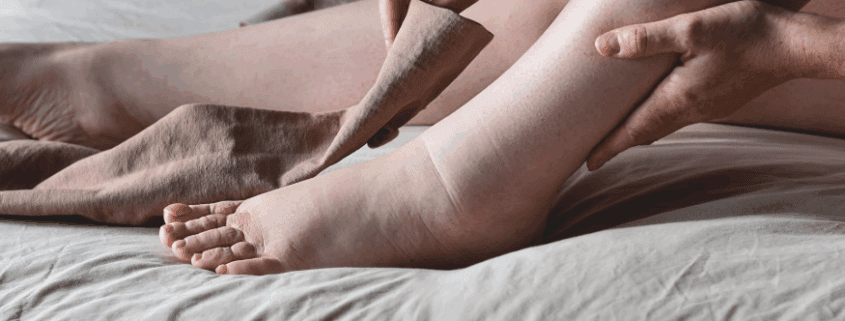 Lymphedema Care with Compression Stockings
